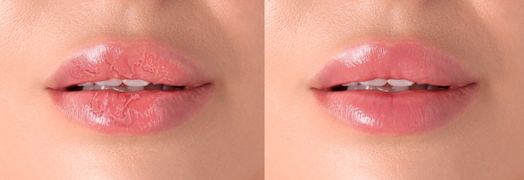 Image of Lip care. Woman with chapped and dry skin before and healthy skin after moisturizing treatment, collage