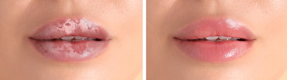 Image of Lip care. Woman with chapped and dry skin before and healthy skin after moisturizing treatment, collage