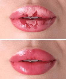 Image of Lip care. Woman with chapped and dry skin before and healthy skin after moisturizing treatment, collage