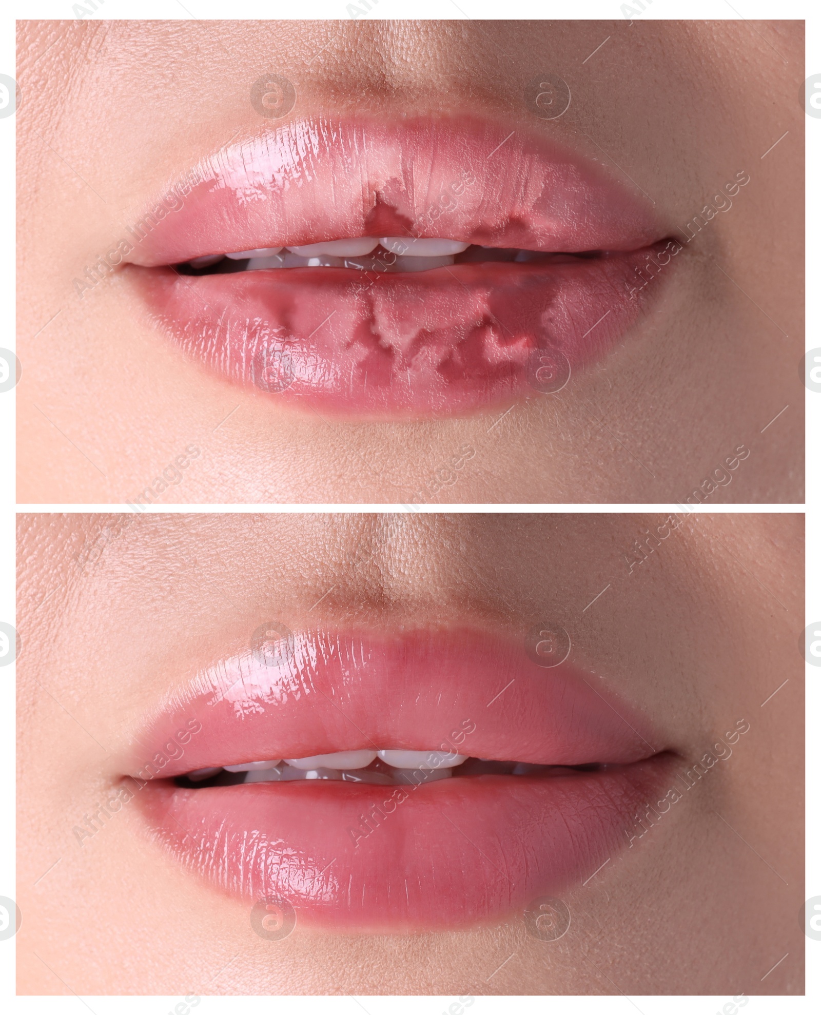 Image of Lip care. Woman with chapped and dry skin before and healthy skin after moisturizing treatment, collage