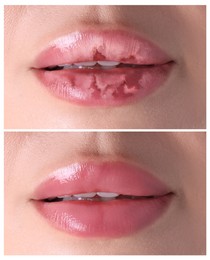 Image of Lip care. Woman with chapped and dry skin before and healthy skin after moisturizing treatment, collage