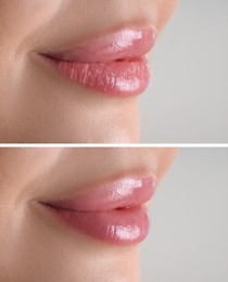 Image of Lip care. Woman with chapped and dry skin before and healthy skin after moisturizing treatment, closeup. Collage on grey background