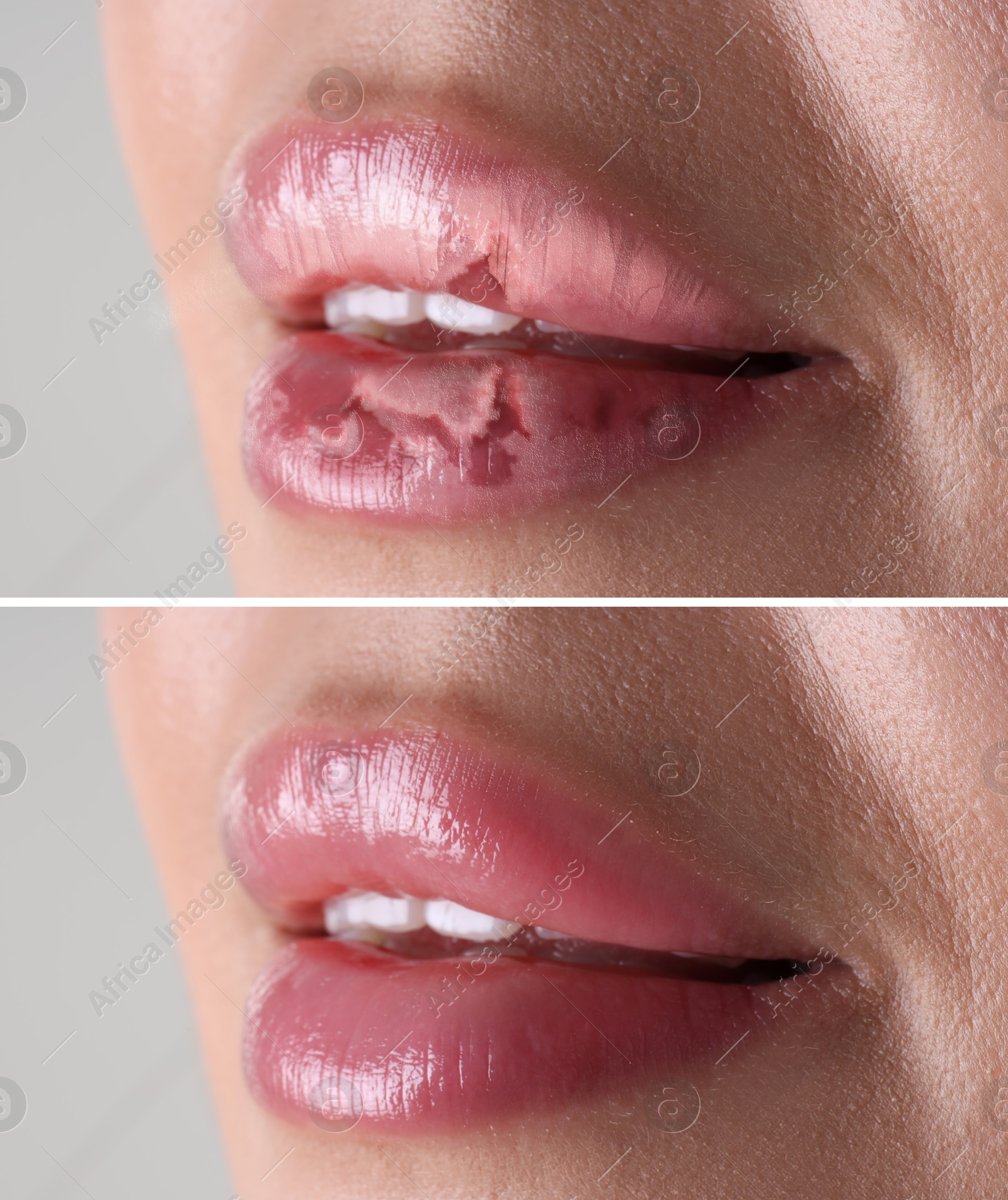 Image of Lip care. Woman with chapped and dry skin before and healthy skin after moisturizing treatment, closeup. Collage on grey background