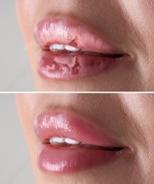 Image of Lip care. Woman with chapped and dry skin before and healthy skin after moisturizing treatment, closeup. Collage on grey background