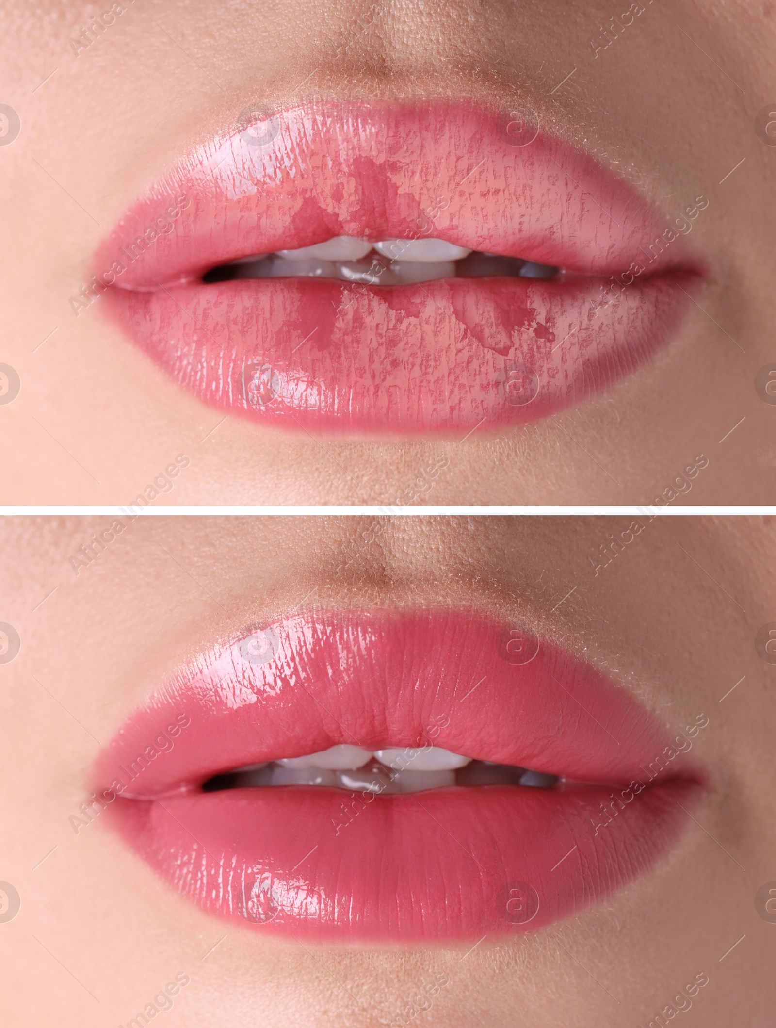 Image of Lip care. Woman with chapped and dry skin before and healthy skin after moisturizing treatment, collage