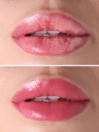 Image of Lip care. Woman with chapped and dry skin before and healthy skin after moisturizing treatment, collage