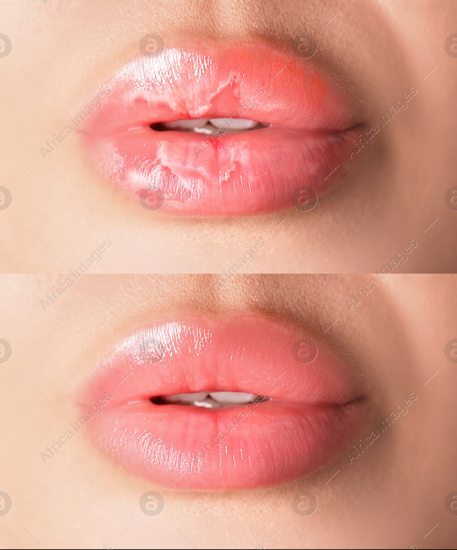 Image of Lip care. Woman with chapped and dry skin before and healthy skin after moisturizing treatment, collage