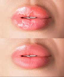 Image of Lip care. Woman with chapped and dry skin before and healthy skin after moisturizing treatment, collage