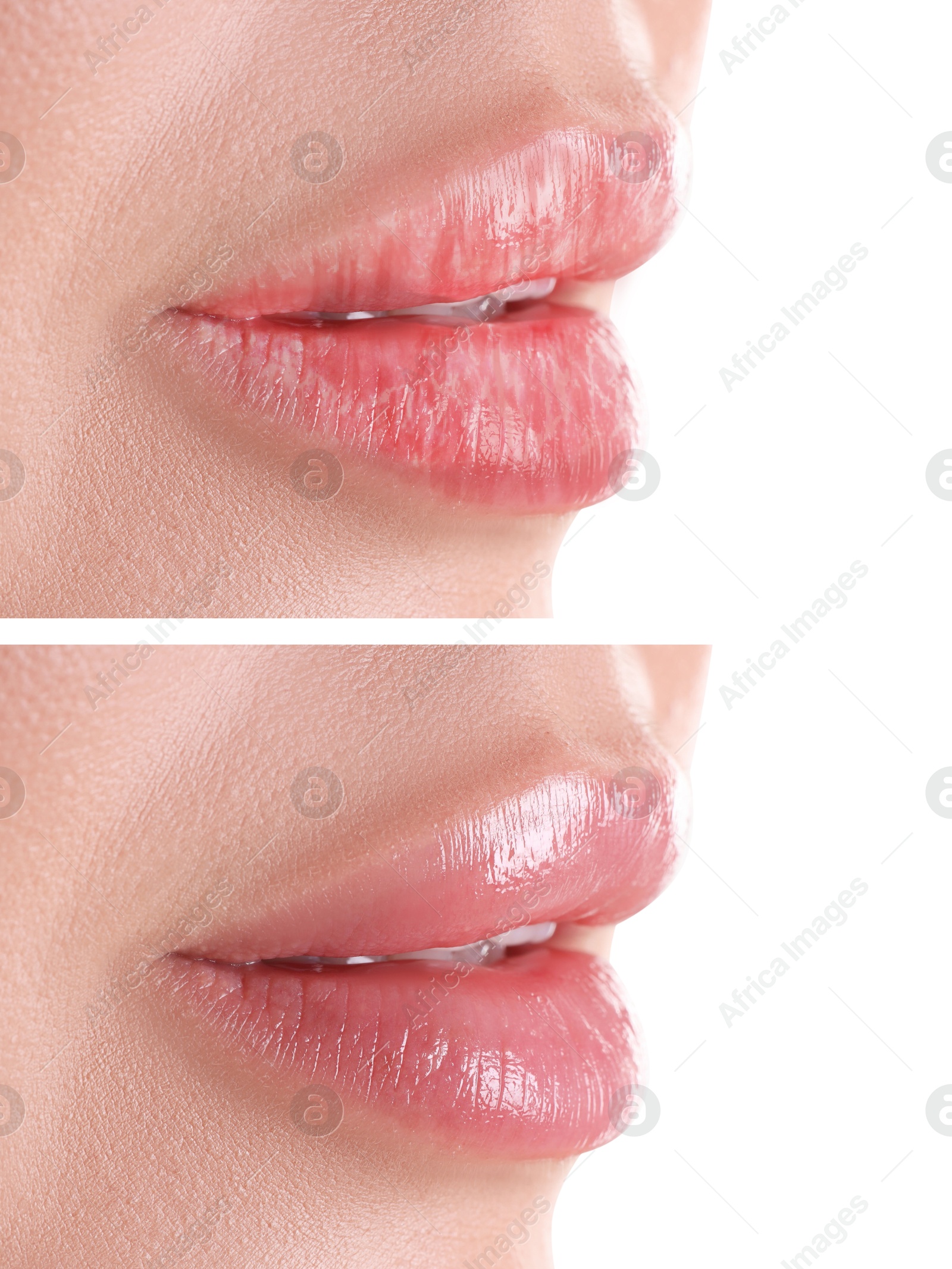Image of Lip care. Woman with chapped and dry skin before and healthy skin after moisturizing treatment, closeup. Collage on white background