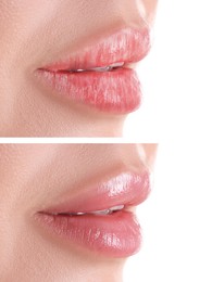 Image of Lip care. Woman with chapped and dry skin before and healthy skin after moisturizing treatment, closeup. Collage on white background