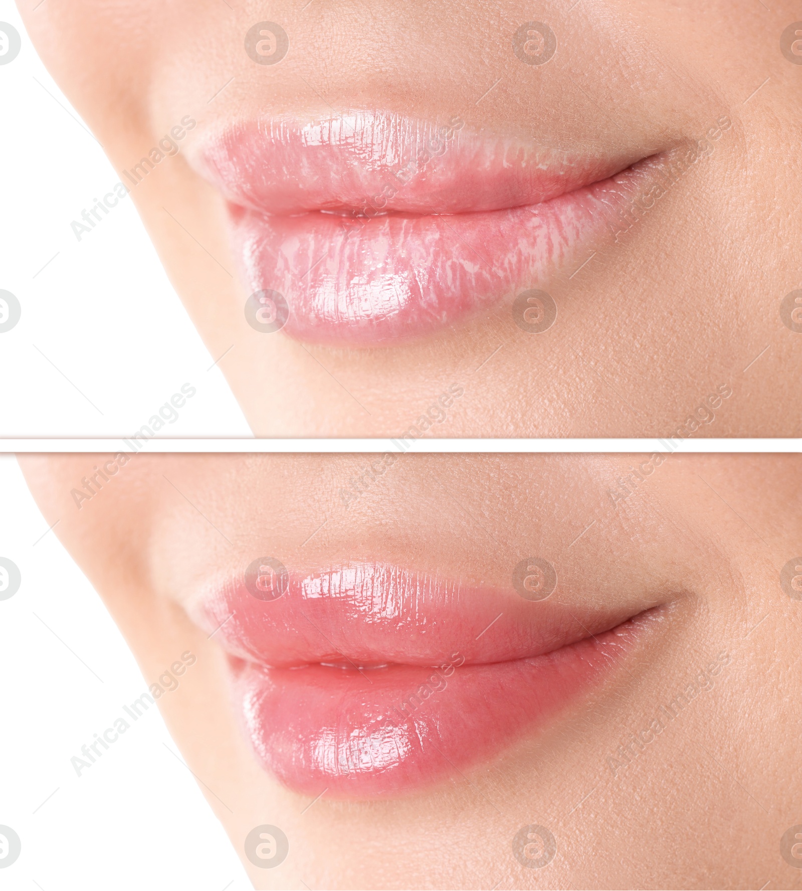 Image of Lip care. Woman with chapped and dry skin before and healthy skin after moisturizing treatment, closeup. Collage on white background