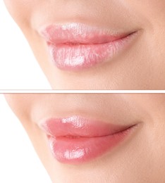 Image of Lip care. Woman with chapped and dry skin before and healthy skin after moisturizing treatment, closeup. Collage on white background