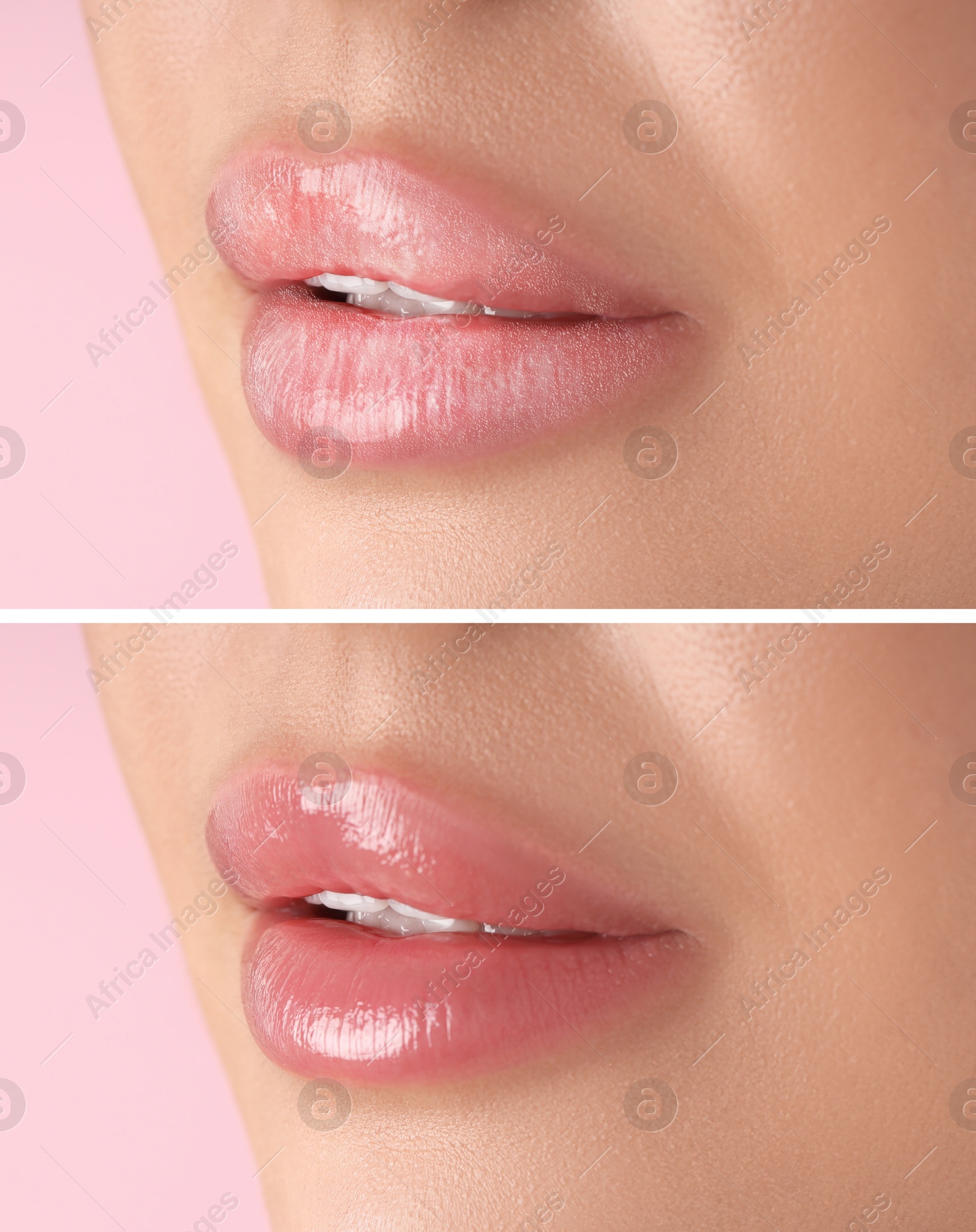 Image of Lip care. Woman with chapped and dry skin before and healthy skin after moisturizing treatment, closeup. Collage on pink background
