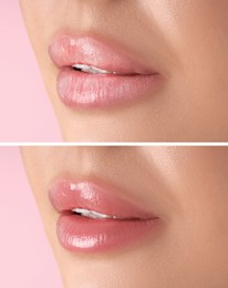 Image of Lip care. Woman with chapped and dry skin before and healthy skin after moisturizing treatment, closeup. Collage on pink background