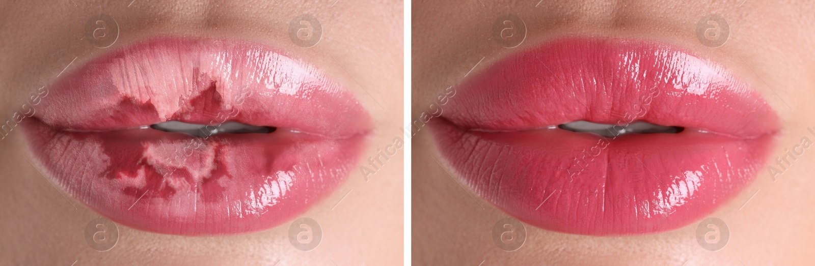 Image of Lip care. Woman with chapped and dry skin before and healthy skin after moisturizing treatment, collage