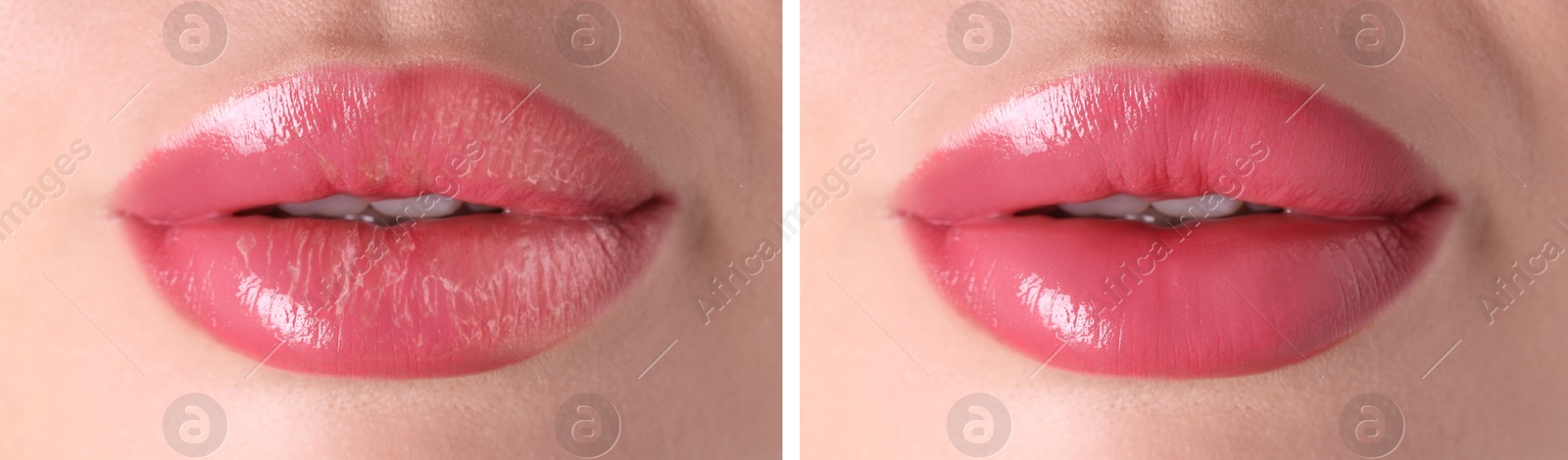 Image of Lip care. Woman with chapped and dry skin before and healthy skin after moisturizing treatment, collage