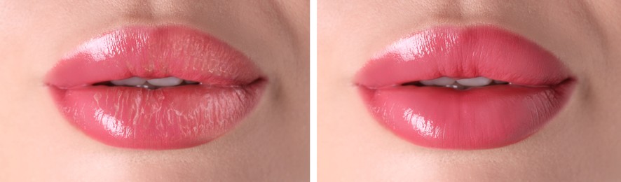 Image of Lip care. Woman with chapped and dry skin before and healthy skin after moisturizing treatment, collage