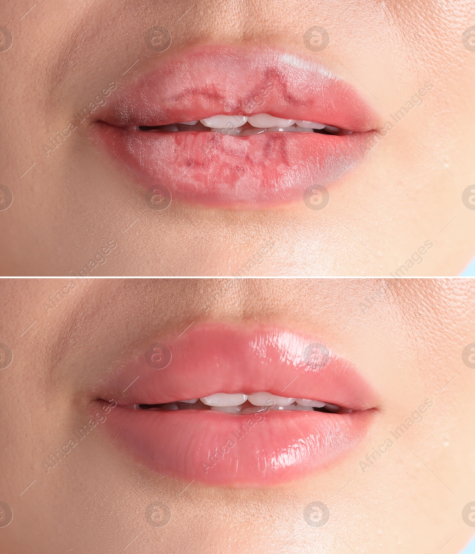 Image of Lip care. Woman with chapped and dry skin before and healthy skin after moisturizing treatment, collage