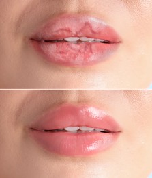 Image of Lip care. Woman with chapped and dry skin before and healthy skin after moisturizing treatment, collage