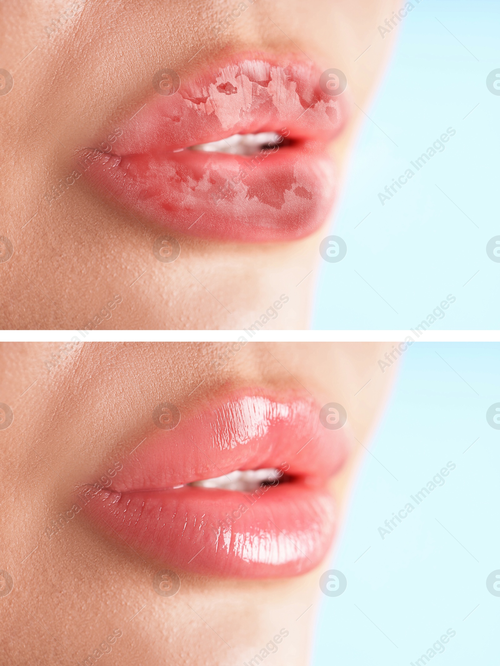 Image of Lip care. Woman with chapped and dry skin before and healthy skin after moisturizing treatment, closeup. Collage on light background