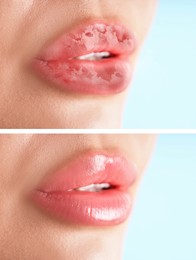 Image of Lip care. Woman with chapped and dry skin before and healthy skin after moisturizing treatment, closeup. Collage on light background