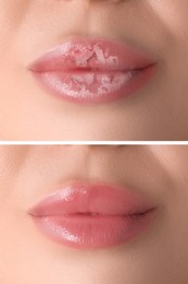 Image of Lip care. Woman with chapped and dry skin before and healthy skin after moisturizing treatment, collage