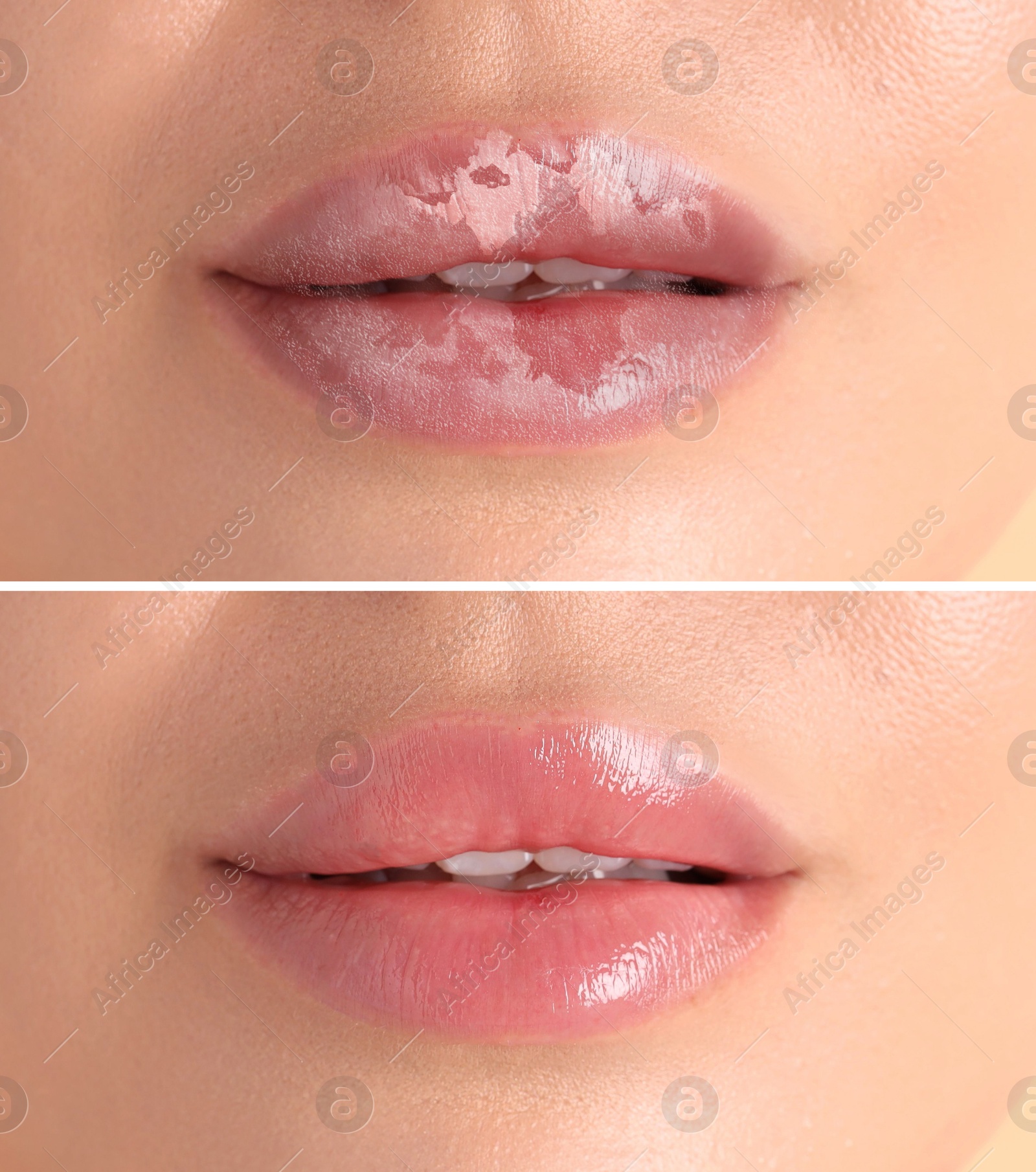 Image of Lip care. Woman with chapped and dry skin before and healthy skin after moisturizing treatment, collage