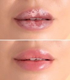 Image of Lip care. Woman with chapped and dry skin before and healthy skin after moisturizing treatment, collage
