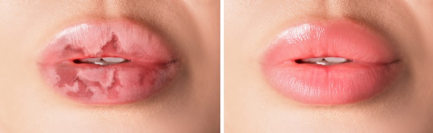 Image of Lip care. Woman with chapped and dry skin before and healthy skin after moisturizing treatment, collage