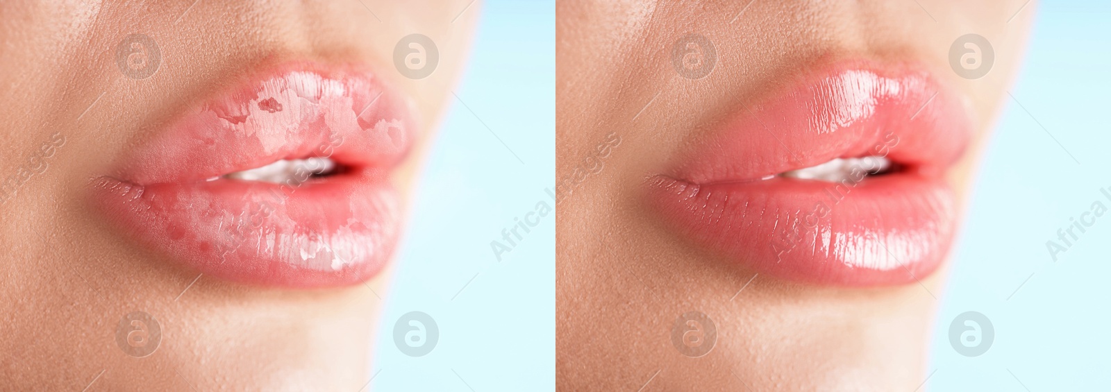 Image of Lip care. Woman with chapped and dry skin before and healthy skin after moisturizing treatment, closeup. Collage on light background