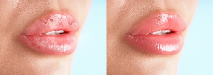 Image of Lip care. Woman with chapped and dry skin before and healthy skin after moisturizing treatment, closeup. Collage on light background