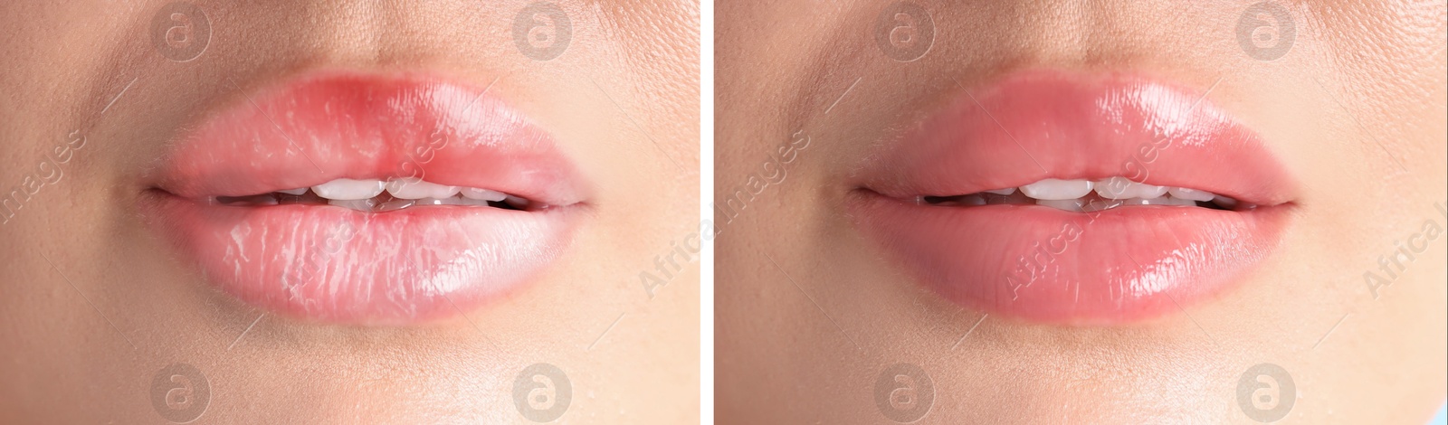 Image of Lip care. Woman with chapped and dry skin before and healthy skin after moisturizing treatment, collage