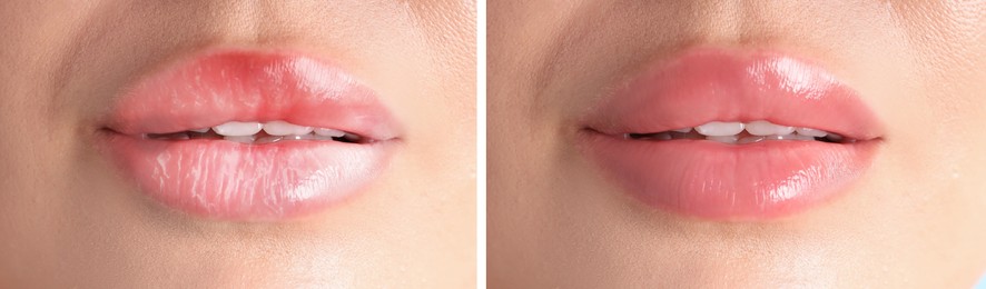 Image of Lip care. Woman with chapped and dry skin before and healthy skin after moisturizing treatment, collage