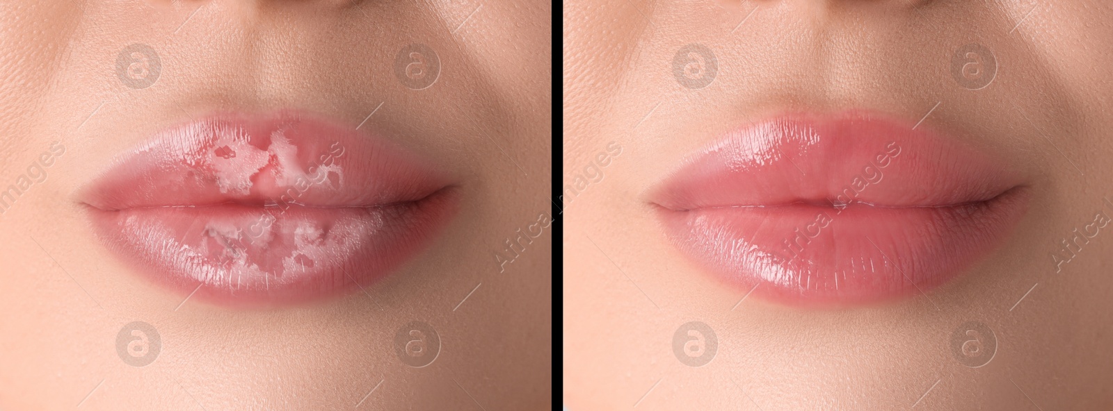 Image of Lip care. Woman with chapped and dry skin before and healthy skin after moisturizing treatment, collage