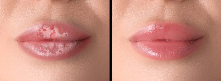 Image of Lip care. Woman with chapped and dry skin before and healthy skin after moisturizing treatment, collage