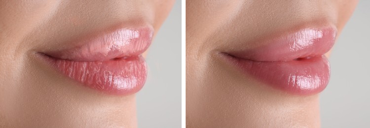 Image of Lip care. Woman with chapped and dry skin before and healthy skin after moisturizing treatment, closeup. Collage on grey background