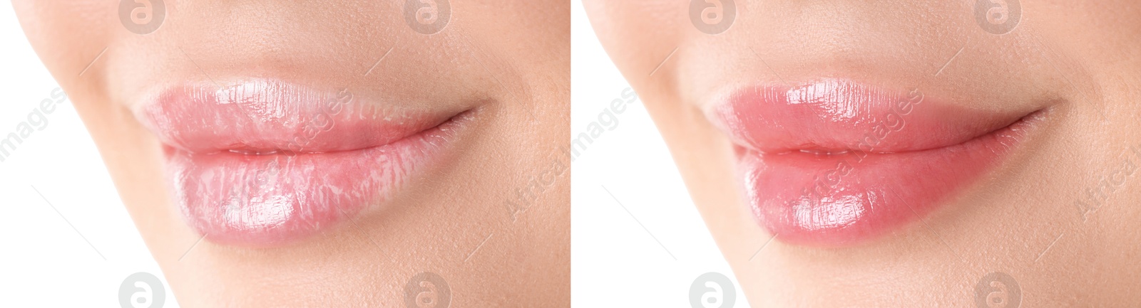 Image of Lip care. Woman with chapped and dry skin before and healthy skin after moisturizing treatment, closeup. Collage on white background