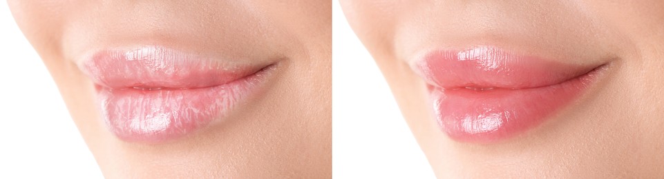 Image of Lip care. Woman with chapped and dry skin before and healthy skin after moisturizing treatment, closeup. Collage on white background