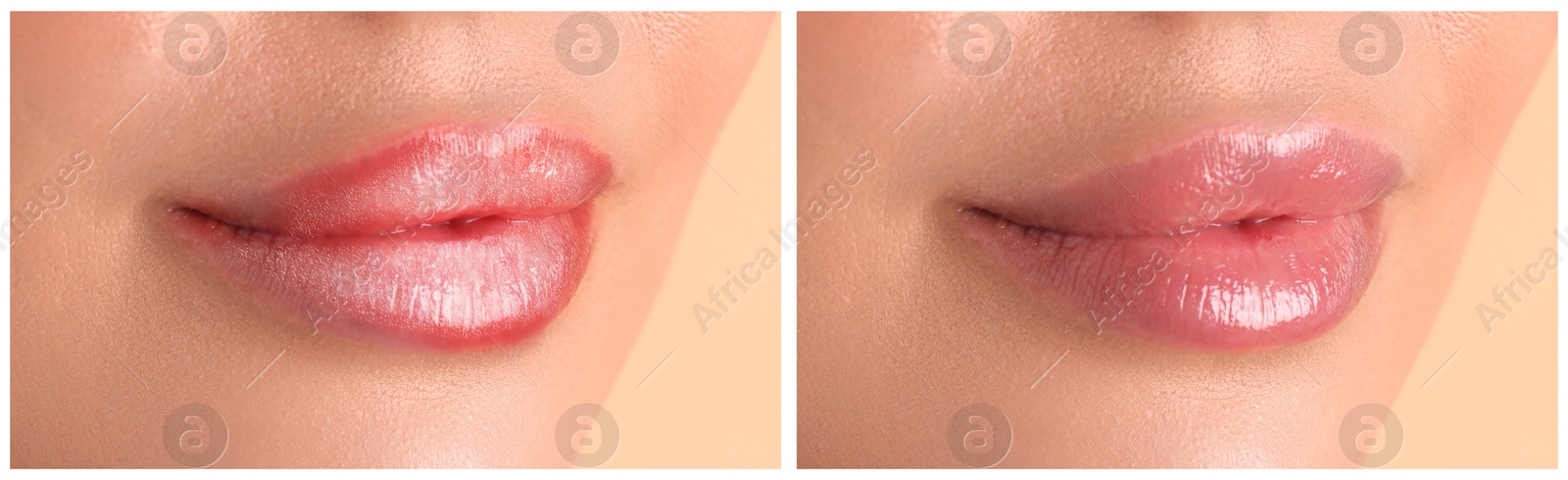 Image of Lip care. Woman with chapped and dry skin before and healthy skin after moisturizing treatment, collage