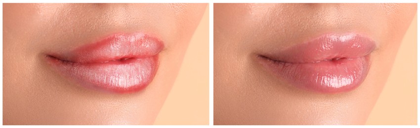 Image of Lip care. Woman with chapped and dry skin before and healthy skin after moisturizing treatment, collage