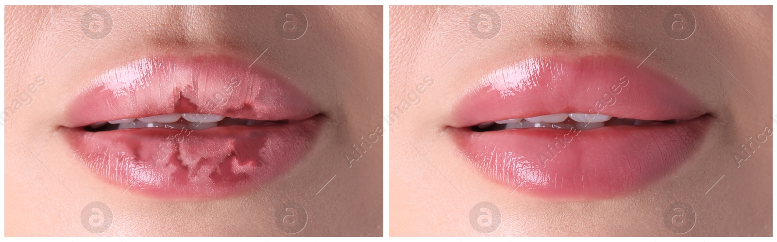 Image of Lip care. Woman with chapped and dry skin before and healthy skin after moisturizing treatment, collage