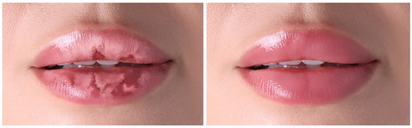 Image of Lip care. Woman with chapped and dry skin before and healthy skin after moisturizing treatment, collage