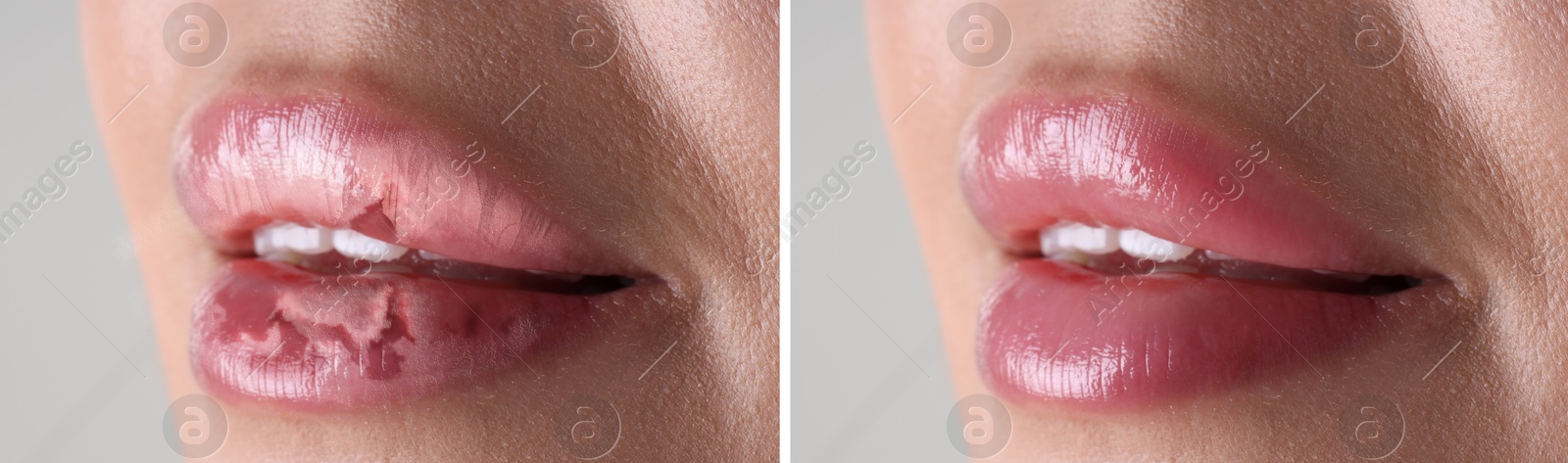 Image of Lip care. Woman with chapped and dry skin before and healthy skin after moisturizing treatment, closeup. Collage on grey background