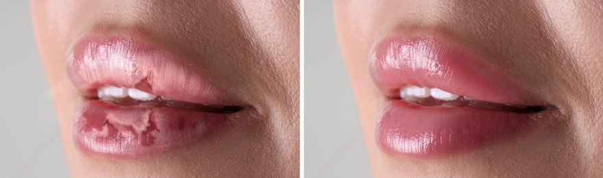 Image of Lip care. Woman with chapped and dry skin before and healthy skin after moisturizing treatment, closeup. Collage on grey background