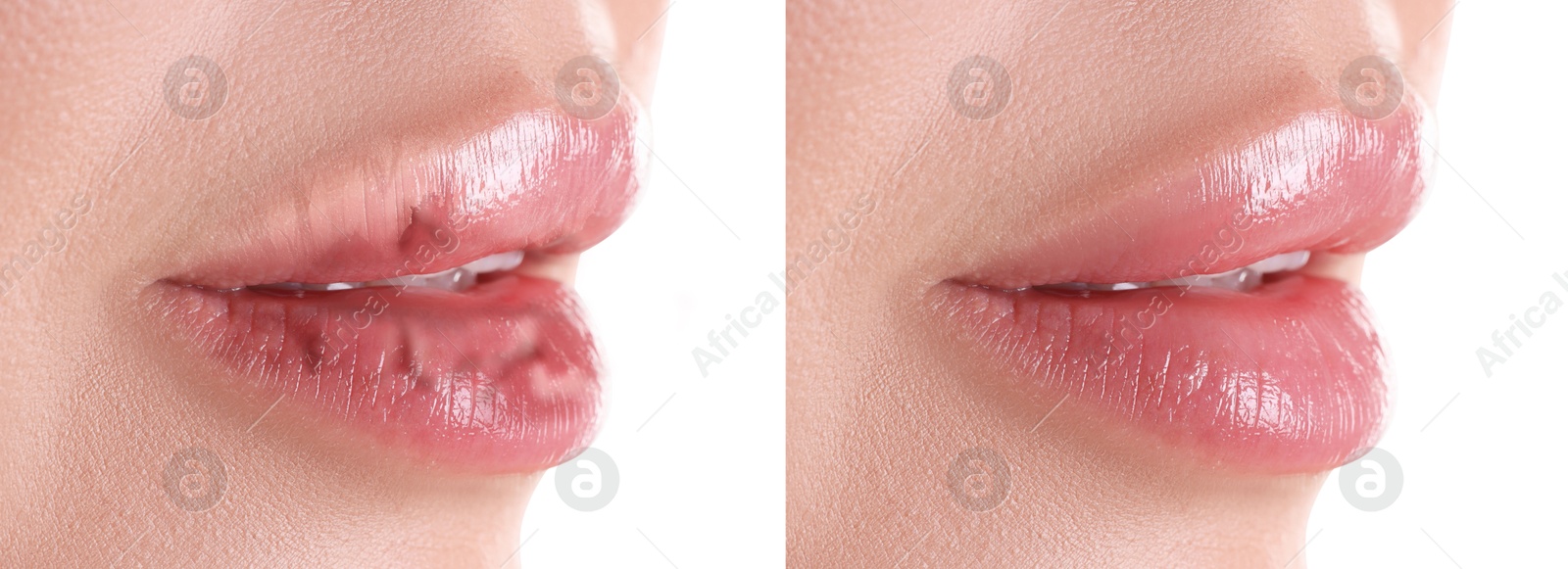 Image of Lip care. Woman with chapped and dry skin before and healthy skin after moisturizing treatment, closeup. Collage on white background
