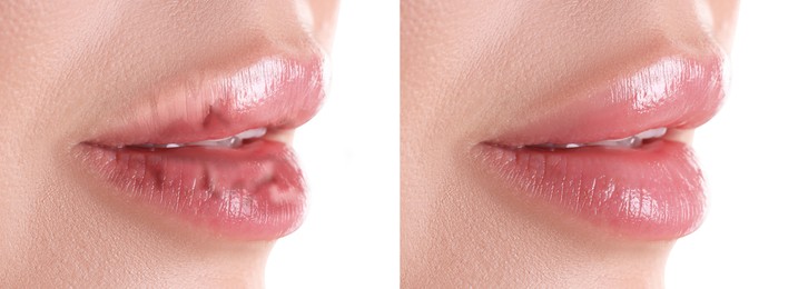Image of Lip care. Woman with chapped and dry skin before and healthy skin after moisturizing treatment, closeup. Collage on white background