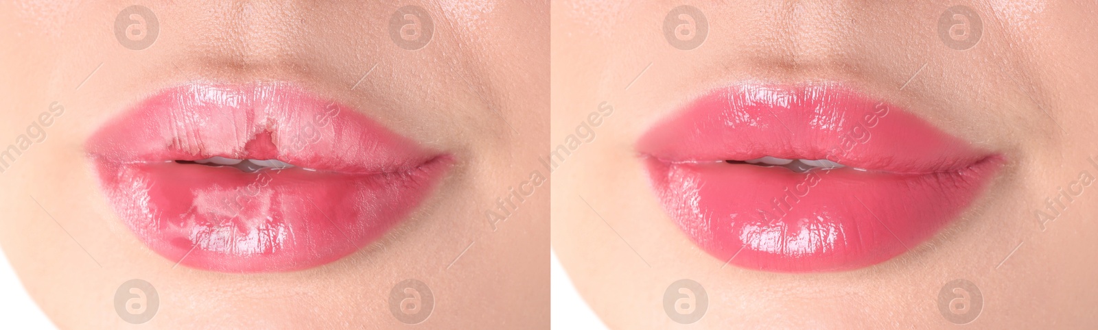 Image of Lip care. Woman with chapped and dry skin before and healthy skin after moisturizing treatment, collage