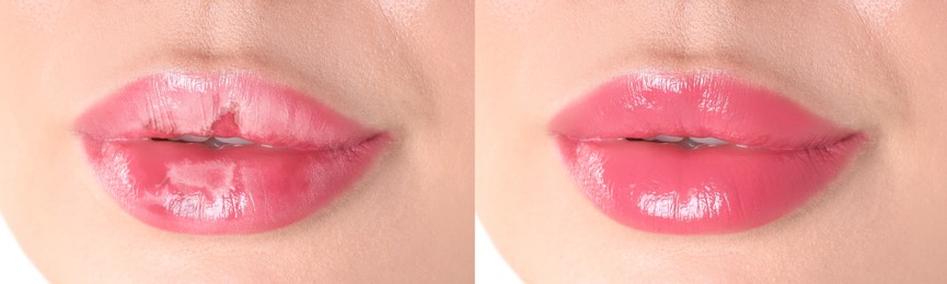Image of Lip care. Woman with chapped and dry skin before and healthy skin after moisturizing treatment, collage