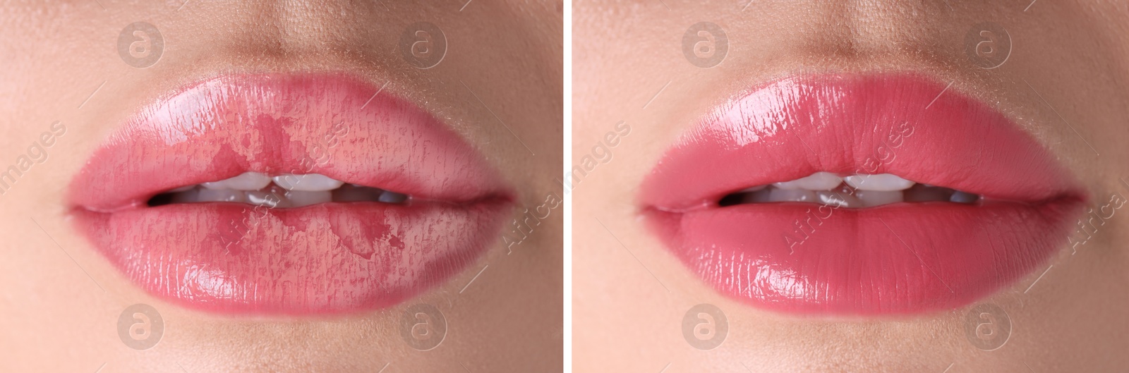 Image of Lip care. Woman with chapped and dry skin before and healthy skin after moisturizing treatment, collage