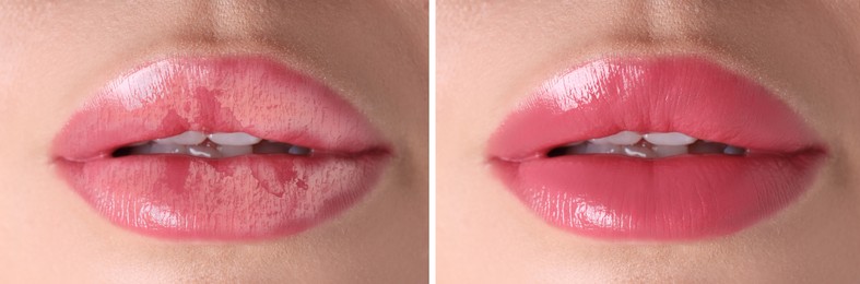 Image of Lip care. Woman with chapped and dry skin before and healthy skin after moisturizing treatment, collage